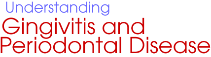 Understanding gingivitis and Periodontal Disease
