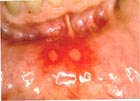 canker sore