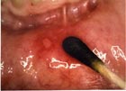 canker sore treatment