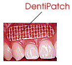 The DentiPatch for needle-less dentistry